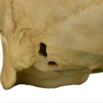Replica Human Female with Multiple Gunshot Wounds Skull