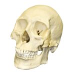 Replica Human Skull – Healed Trauma