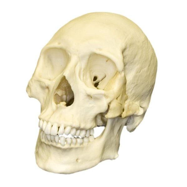 Replica Human Skull – Healed Trauma