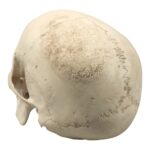 Replica Human Skull – Porotic Hyperostosis and Cribra Orbitalia
