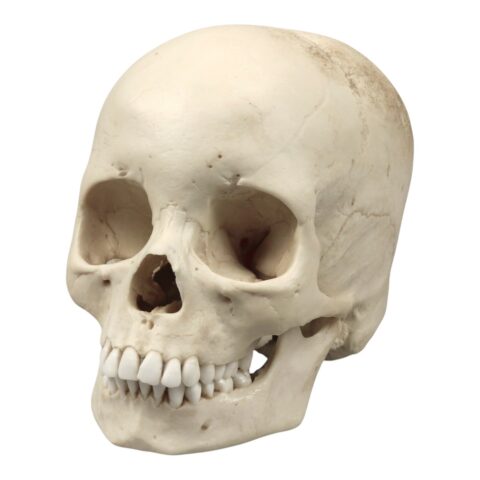 Replica Human Skull - Porotic Hyperostosis and Cribra Orbitalia