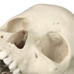 Replica Human Skull – Porotic Hyperostosis and Cribra Orbitalia
