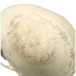 Replica Human Skull – Porotic Hyperostosis and Cribra Orbitalia