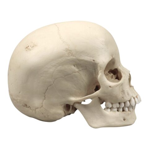 Replica Human Skull - Porotic Hyperostosis and Cribra Orbitalia