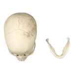 Replica Human Skull – Porotic Hyperostosis and Cribra Orbitalia