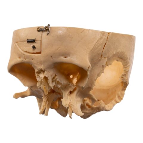 Real Human Partial Skull - Dissected - 332 g