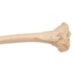 Real Human Left Tibia – Pathology