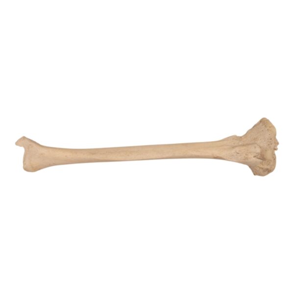 Real Human Left Tibia – Pathology