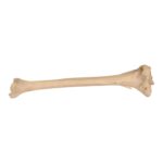 Real Human Left Tibia – Pathology