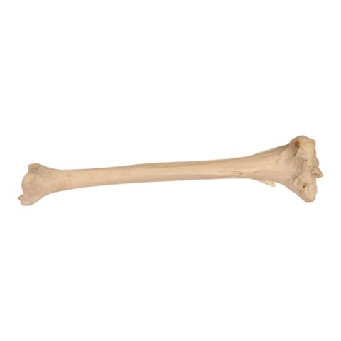 Real Human Left Tibia - Pathology