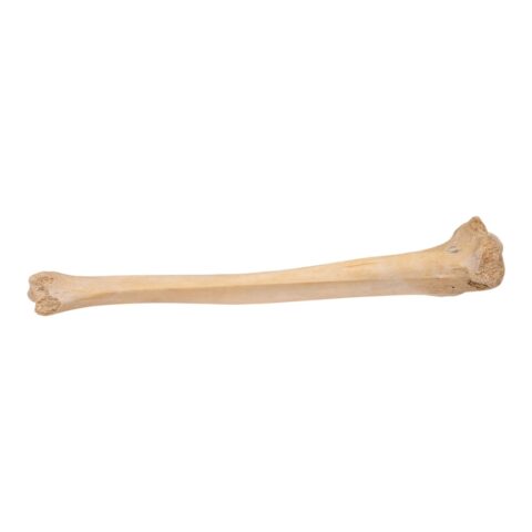 Real Human Tibia - Pathology
