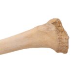 Real Human Tibia – Pathology