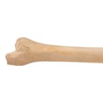 Real Human Tibia – Pathology