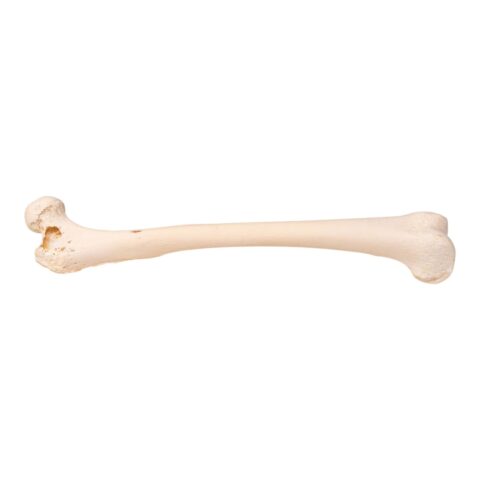 Real Human Femur - Pathology