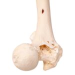 Real Human Femur – Pathology