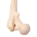 Real Human Femur – Pathology