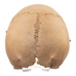 Real Human Calvaria with Hardware