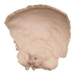 Real Human Fused Parietal and Temporal Bone