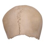 Real Human Partial Cranial Vault