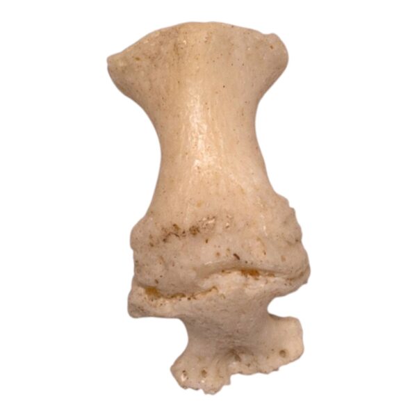 Real Human Phalange – Pathology