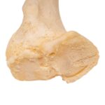 Real Human Left Leg – Pathology