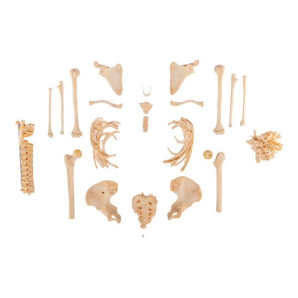 Real Human Skeleton – Partial – Pathology