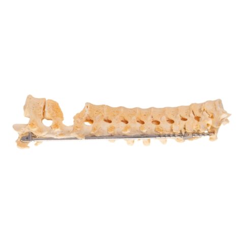 Real Human Skeleton - Partial - Pathology