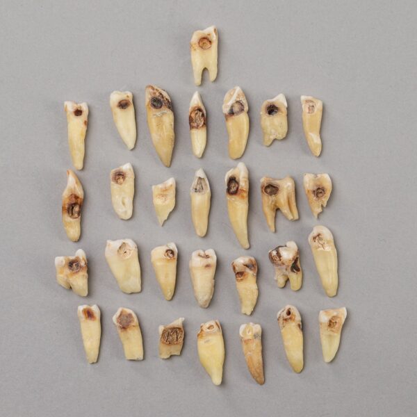 Real Human Tooth with Decay – Single