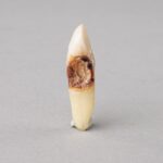 Real Human Tooth with Decay – Single