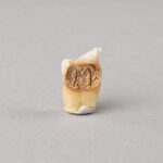 Real Human Tooth with Decay – Single