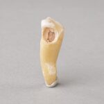 Real Human Tooth with Decay – Single