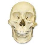 Replica Human Skull – Healed Trauma