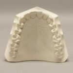 Replica Orthodontic Study Model