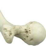 Replica Human Left Femur with Polio