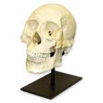 Replica Human Skull – Healed Trauma