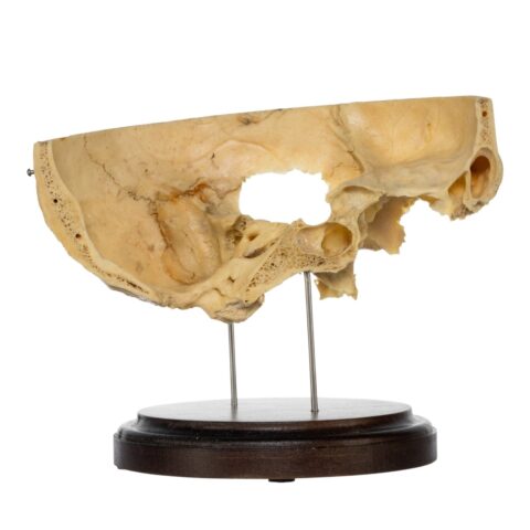 Real Human Partial Skull on Stand - 264 g