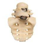 Real Research Quality Human Skeleton – Disarticulated (Pathology)
