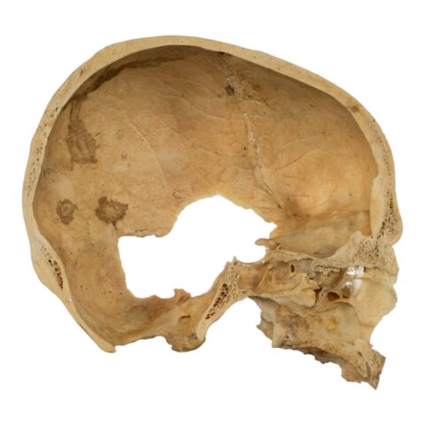 Real Human Skull - Partial - 230 g