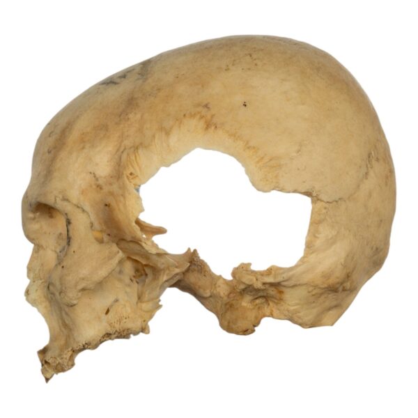Real Human Skull – Partial – 230 g