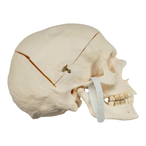 Real Research Quality Human Skull - Pathology