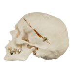 Real Research Quality Human Skull – Pathology