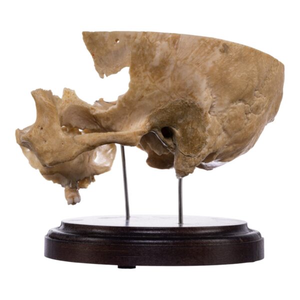Real Human Partial Skull on Stand – 232 g