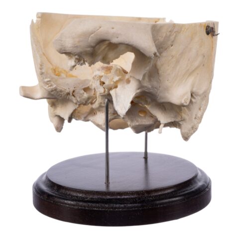 Real Human Partial Skull on Stand - 322 g