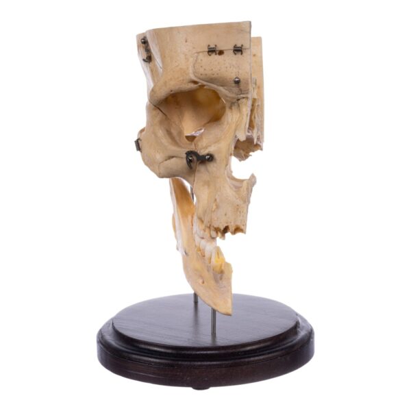 Real Human Partial Skull – Dissected