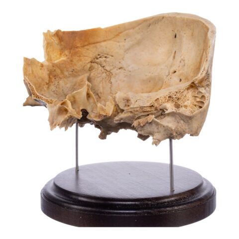 Real Human Partial Skull on Stand - 274 g
