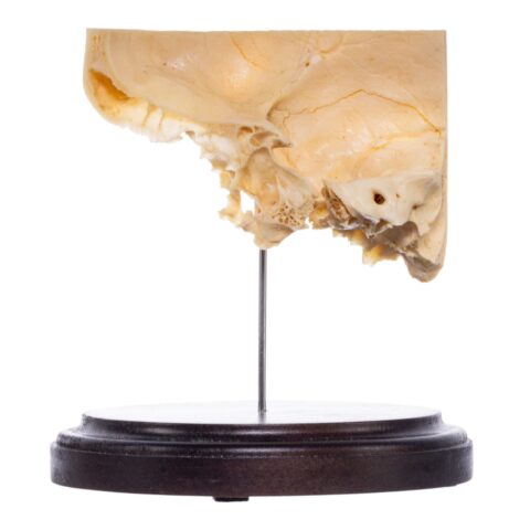 Real Human Partial Skull on Stand - 186 g