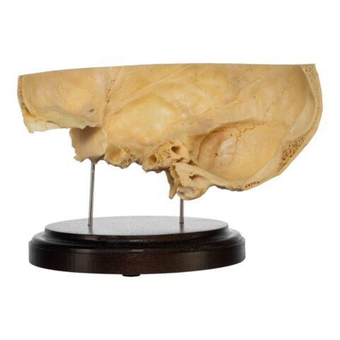 Real Human Partial Skull on Stand - 232 g