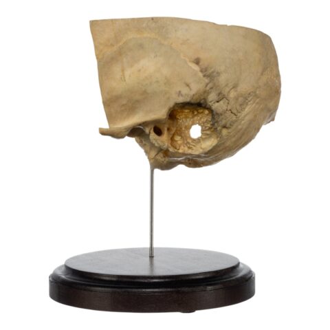 Real Human Partial Skull on Stand - 202 g