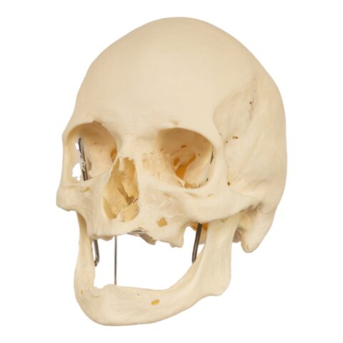 Real Research Quality Human Skeleton - Disarticulated (Pathology)