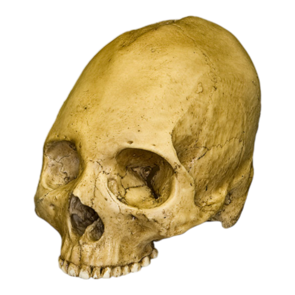 Replica Human Skull – Trephined